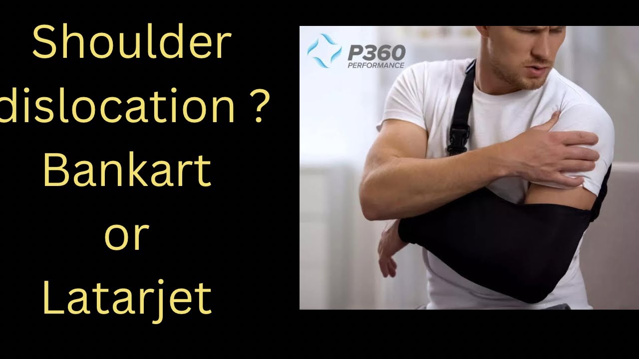 Shoulder dislocation problem which is better Latarjet or Bankart arthroscopic repair